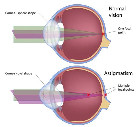 astigmatism test results|Testing for Astigmatism: What You Need to Know .